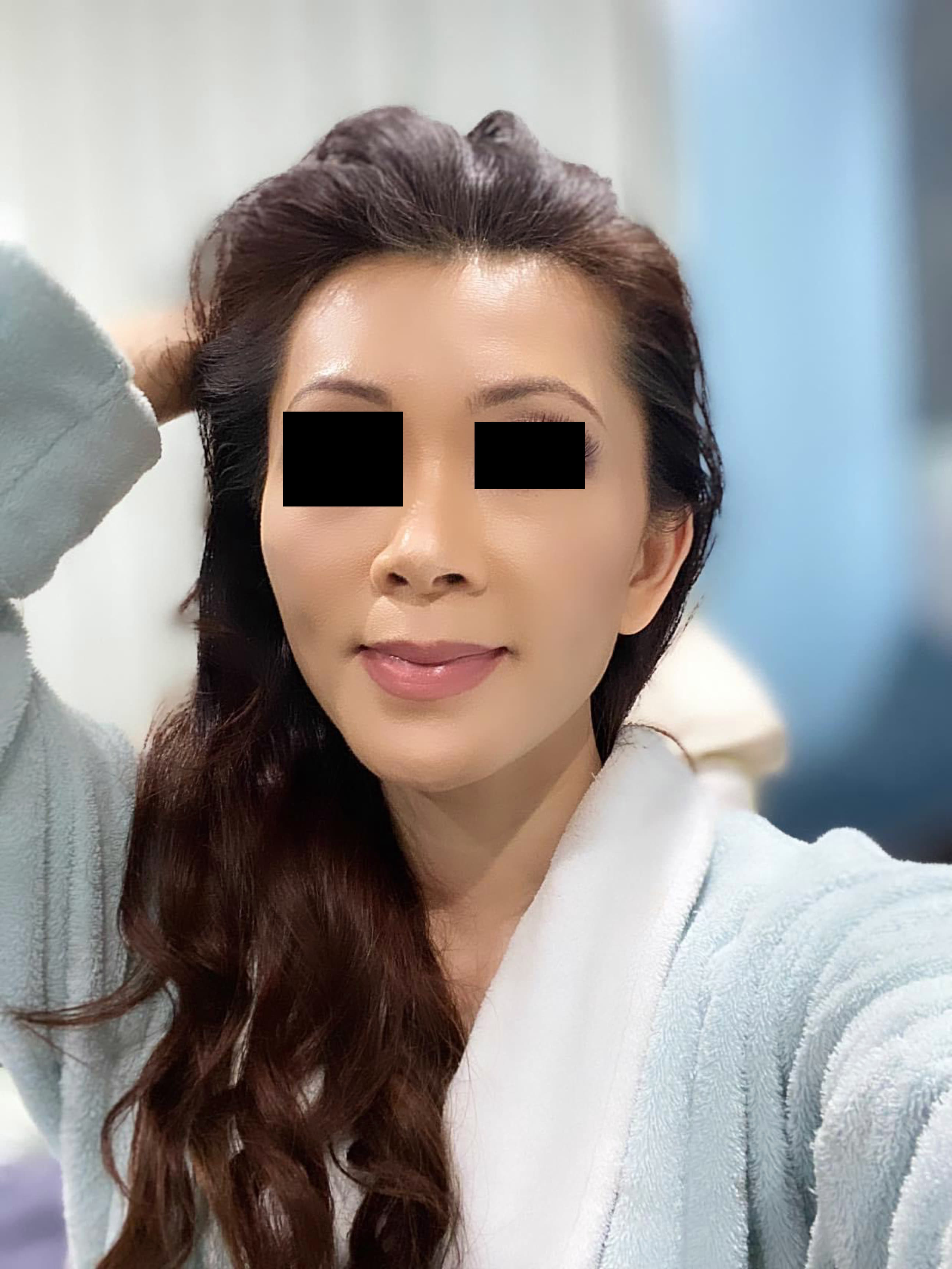 CO2 Skin Resurfacing Final Result