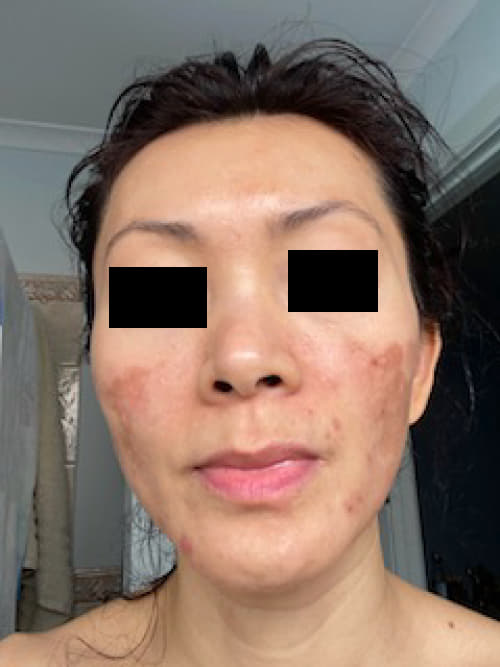 CO2 Skin Resurfacing Immediate Post-Treatment