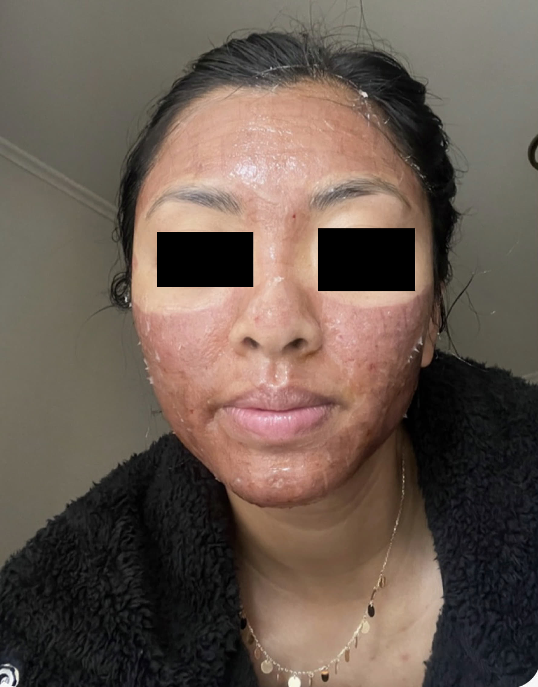 Fractional CO2 Laser Healed Complexion