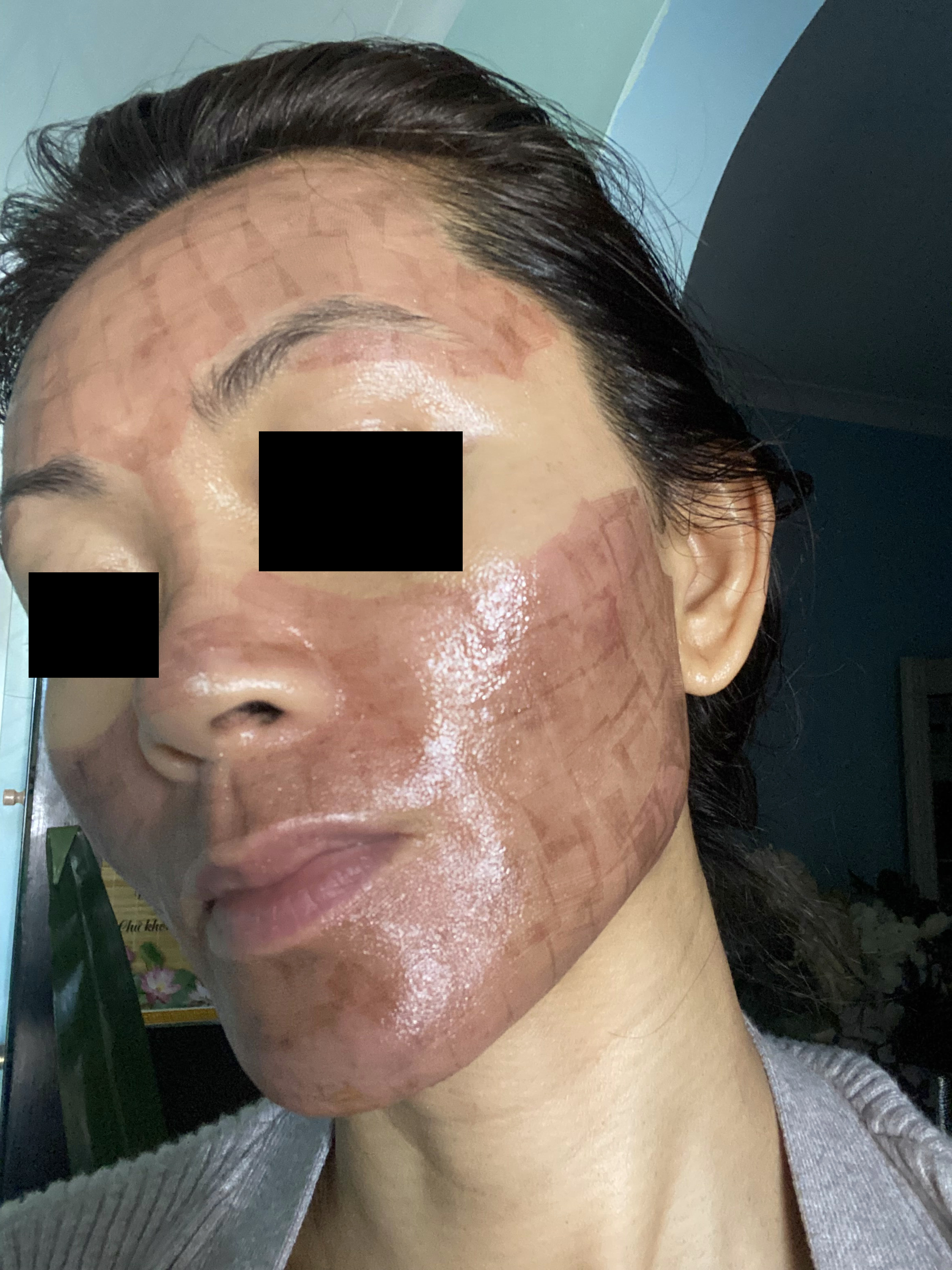 CO2 Skin Resurfacing Healing Micro-Crusts